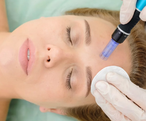 Trabajo de Microneedling en piel de mujer